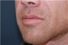 Lip Augmentation/Enhancement After Photo by Steve Laverson, MD, FACS; Rancho Santa Fe, CA - Case 49329