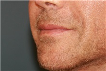 Lip Augmentation/Enhancement Before Photo by Steve Laverson, MD, FACS; Rancho Santa Fe, CA - Case 49329