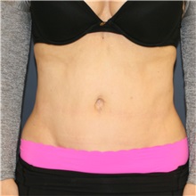 Tummy Tuck After Photo by Steve Laverson, MD, FACS; Rancho Santa Fe, CA - Case 49328