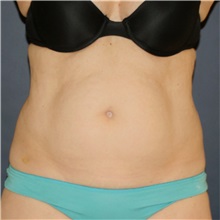 Tummy Tuck Before Photo by Steve Laverson, MD, FACS; Rancho Santa Fe, CA - Case 49328