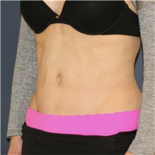 Tummy Tuck After Photo by Steve Laverson, MD, FACS; Rancho Santa Fe, CA - Case 49328