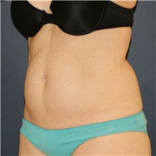 Tummy Tuck Before Photo by Steve Laverson, MD, FACS; Rancho Santa Fe, CA - Case 49328