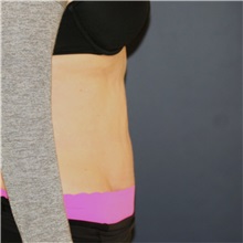 Tummy Tuck After Photo by Steve Laverson, MD, FACS; Rancho Santa Fe, CA - Case 49328