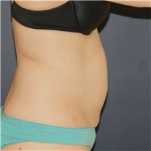 Tummy Tuck Before Photo by Steve Laverson, MD, FACS; Rancho Santa Fe, CA - Case 49328