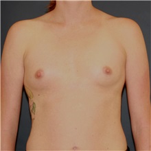 Breast Augmentation Before Photo by Steve Laverson, MD, FACS; Rancho Santa Fe, CA - Case 49327