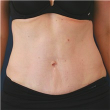 Tummy Tuck After Photo by Steve Laverson, MD, FACS; Rancho Santa Fe, CA - Case 50099 Tummy Tuck After Photo by Steve Laverson, MD, FACS; Rancho Santa Fe, CA - Case 50099