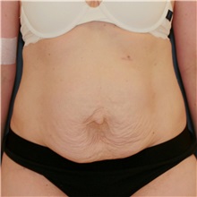 Tummy Tuck Before Photo by Steve Laverson, MD, FACS; Rancho Santa Fe, CA - Case 50099 Tummy Tuck Before Photo by Steve Laverson, MD, FACS; Rancho Santa Fe, CA - Case 50099