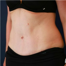 Tummy Tuck After Photo by Steve Laverson, MD, FACS; Rancho Santa Fe, CA - Case 50099