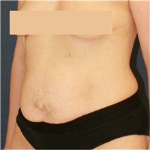 Tummy Tuck Before Photo by Steve Laverson, MD, FACS; Rancho Santa Fe, CA - Case 50099