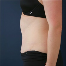 Tummy Tuck After Photo by Steve Laverson, MD, FACS; Rancho Santa Fe, CA - Case 50099