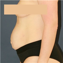 Tummy Tuck Before Photo by Steve Laverson, MD, FACS; Rancho Santa Fe, CA - Case 50099
