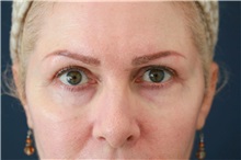Eyelid Surgery After Photo by Steve Laverson, MD, FACS; Rancho Santa Fe, CA - Case 50137