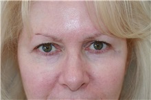 Eyelid Surgery Before Photo by Steve Laverson, MD, FACS; Rancho Santa Fe, CA - Case 50137