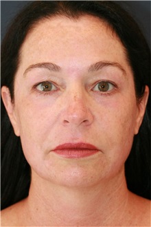 Laser Skin Resurfacing After Photo by Steve Laverson, MD, FACS; , - Case 50219 Laser Skin Resurfacing After Photo by Steve Laverson, MD, FACS; , - Case 50219