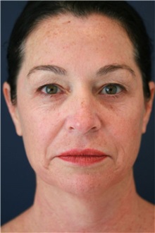 Laser Skin Resurfacing Before Photo by Steve Laverson, MD, FACS; , - Case 50219 Laser Skin Resurfacing Before Photo by Steve Laverson, MD, FACS; , - Case 50219