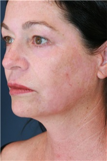 Laser Skin Resurfacing After Photo by Steve Laverson, MD, FACS; ,  - Case 50219