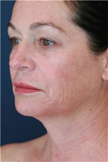 Laser Skin Resurfacing Before Photo by Steve Laverson, MD, FACS; ,  - Case 50219