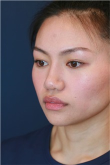 Rhinoplasty After Photo by Steve Laverson, MD, FACS; , - Case 50221 Rhinoplasty After Photo by Steve Laverson, MD, FACS; , - Case 50221