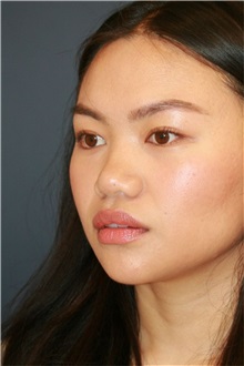 Rhinoplasty Before Photo by Steve Laverson, MD, FACS; , - Case 50221 Rhinoplasty Before Photo by Steve Laverson, MD, FACS; , - Case 50221