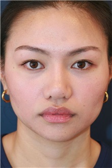 Rhinoplasty After Photo by Steve Laverson, MD, FACS; ,  - Case 50221