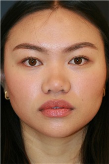 Rhinoplasty Before Photo by Steve Laverson, MD, FACS; ,  - Case 50221