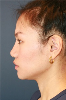 Rhinoplasty After Photo by Steve Laverson, MD, FACS; ,  - Case 50221