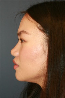Rhinoplasty Before Photo by Steve Laverson, MD, FACS; ,  - Case 50221