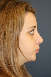 Rhinoplasty After Photo by Steve Laverson, MD, FACS; ,  - Case 50231 Rhinoplasty After Photo by Steve Laverson, MD, FACS; ,  - Case 50231