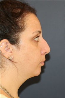 Rhinoplasty Before Photo by Steve Laverson, MD, FACS; ,  - Case 50231 Rhinoplasty Before Photo by Steve Laverson, MD, FACS; ,  - Case 50231