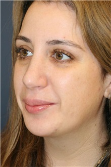Rhinoplasty After Photo by Steve Laverson, MD, FACS; ,  - Case 50231