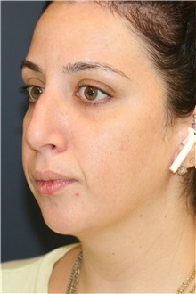 Rhinoplasty Before Photo by Steve Laverson, MD, FACS; ,  - Case 50231