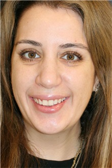Rhinoplasty After Photo by Steve Laverson, MD, FACS; ,  - Case 50231