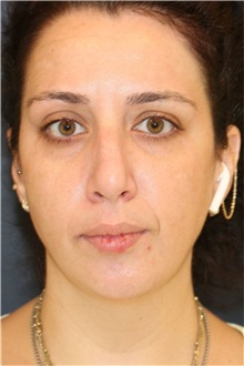 Rhinoplasty Before Photo by Steve Laverson, MD, FACS; ,  - Case 50231