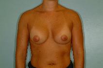 Breast Augmentation After Photo by Fouad Samaha, MD; Quincy, MA - Case 6904