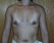 Breast Augmentation Before Photo by Fouad Samaha, MD; Quincy, MA - Case 6904