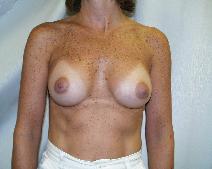 Breast Augmentation After Photo by Fouad Samaha, MD; Quincy, MA - Case 6905