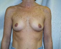 Breast Augmentation Before Photo by Fouad Samaha, MD; Quincy, MA - Case 6905