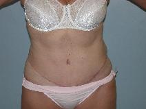 Tummy Tuck After Photo by Fouad Samaha, MD; Quincy, MA - Case 6906