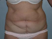 Tummy Tuck Before Photo by Fouad Samaha, MD; Quincy, MA - Case 6906