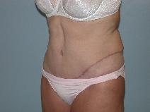 Tummy Tuck After Photo by Fouad Samaha, MD; Quincy, MA - Case 6906