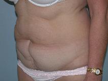 Tummy Tuck Before Photo by Fouad Samaha, MD; Quincy, MA - Case 6906