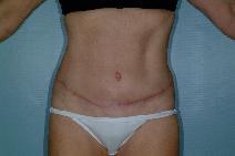 Tummy Tuck After Photo by Fouad Samaha, MD; Quincy, MA - Case 6942