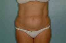 Tummy Tuck Before Photo by Fouad Samaha, MD; Quincy, MA - Case 6942
