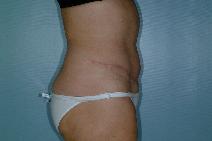 Tummy Tuck After Photo by Fouad Samaha, MD; Quincy, MA - Case 6942