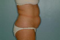 Tummy Tuck Before Photo by Fouad Samaha, MD; Quincy, MA - Case 6942