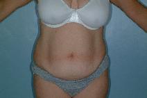 Tummy Tuck Before Photo by Fouad Samaha, MD; Quincy, MA - Case 7085