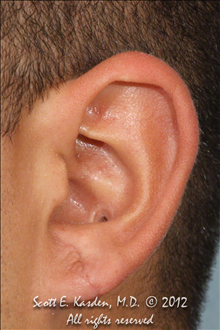 Ear Surgery After Photo by Scott Kasden, MD; Argyle, TX - Case 25294