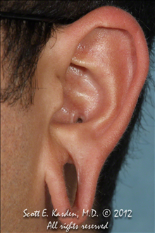 Ear Surgery Before Photo by Scott Kasden, MD; Argyle, TX - Case 25294