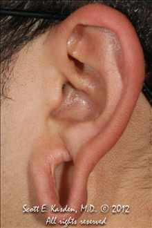 Ear Surgery Before Photo by Scott Kasden, MD; Argyle, TX - Case 25294