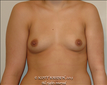 Breast Augmentation Before Photo by Scott Kasden, MD; Argyle, TX - Case 25302
